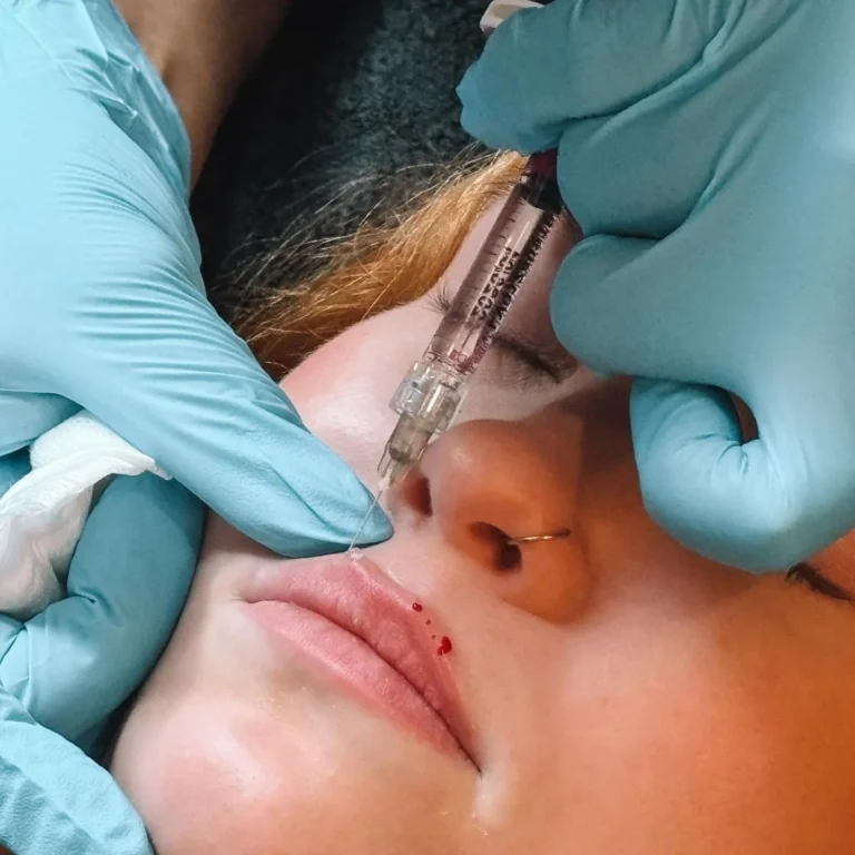 Lähikuva pistoshoidosta, jossa ammattilainen tekee täyteainekäsittelyä huulien alueelle.